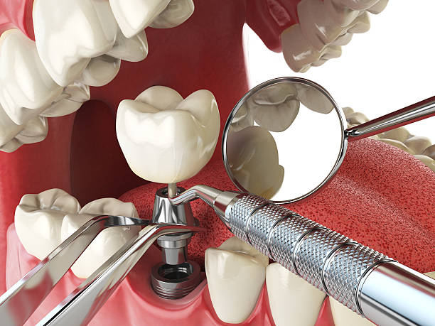Best Emergency Denture Repair in Elwood, IN